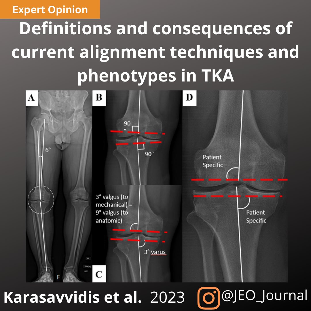 JEO_journal's tweet photo. The concept that a single target alignment approach suits all cases in TKA is being challenged.
This review comprehensively presents the definitions of different alignment techniques in all planes.

OPEN ACCESS article: https://t.co/0hGQpUYsVy

#totalkneereplacement #alignment https://t.co/PxK5cStsE3