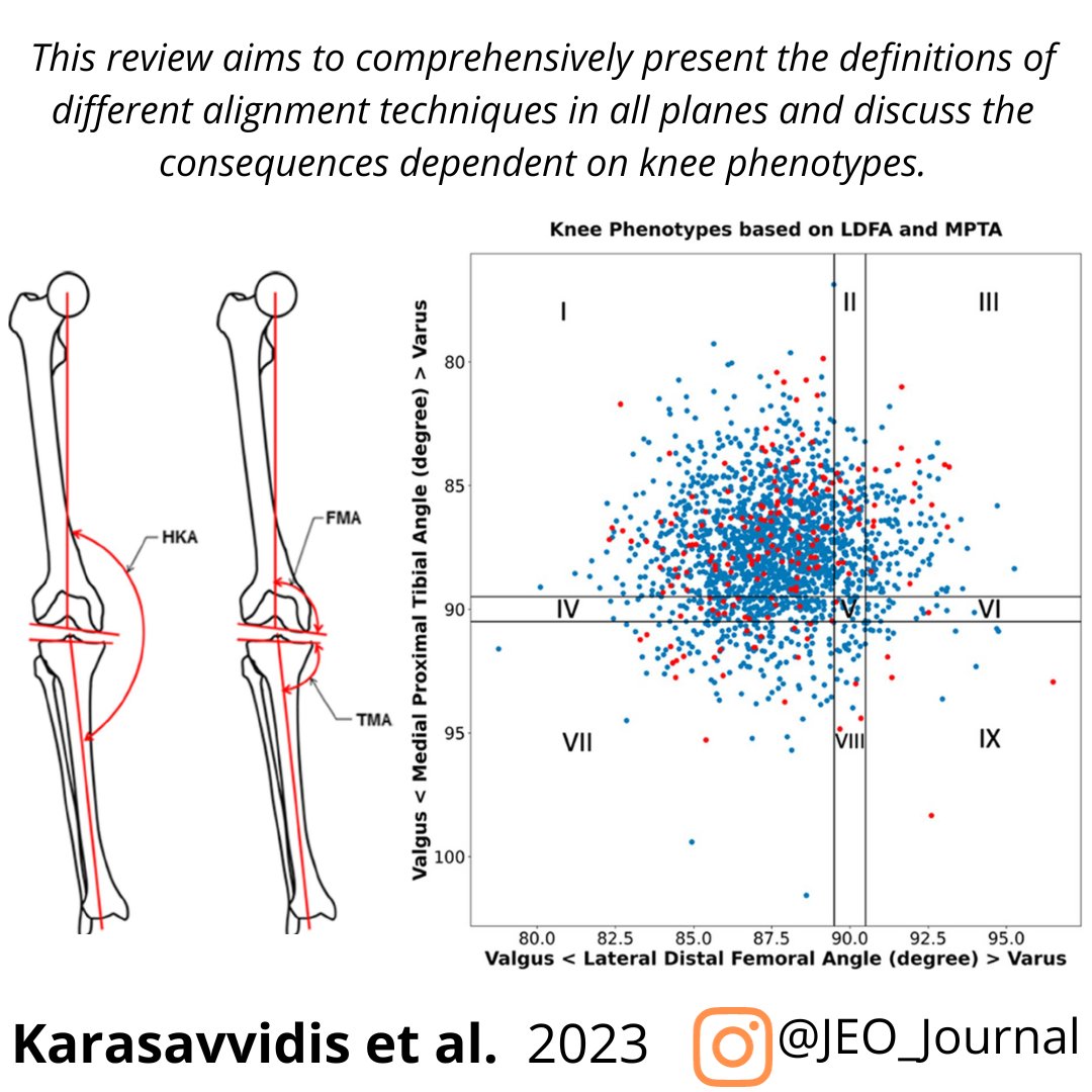 The concept that a single target alignment approach suits all cases in TKA is being challenged.
This review comprehensively presents the definitions of different alignment techniques in all planes.

OPEN ACCESS article: doi.org/10.1186/s40634…

#totalkneereplacement #alignment