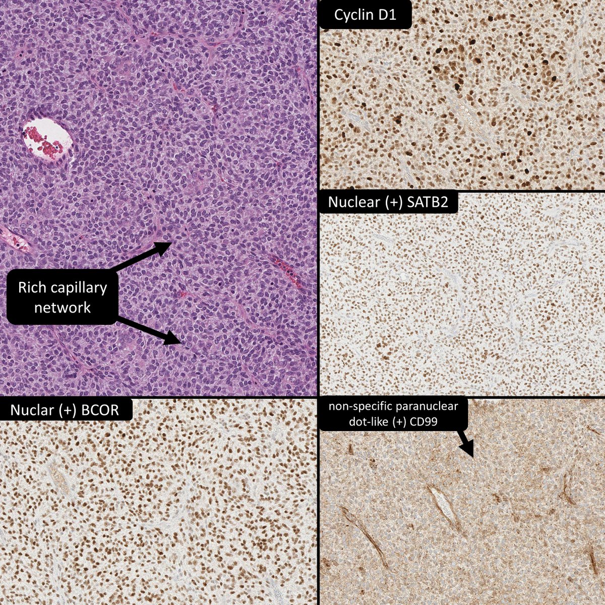 BCOR IHC✅sensitive🚫specific for BCOR-altered Sarcoma
Molecular for each BCOR fusion/ITD isn't available
The IHC (+) trifecta of SATB2, cyclin D1, &amp; BCOR* is specific and essential to diagnose BCOR-altered sarcoma
*each (not all) + in other poorly diff tumors
#BSTPath #PediPath