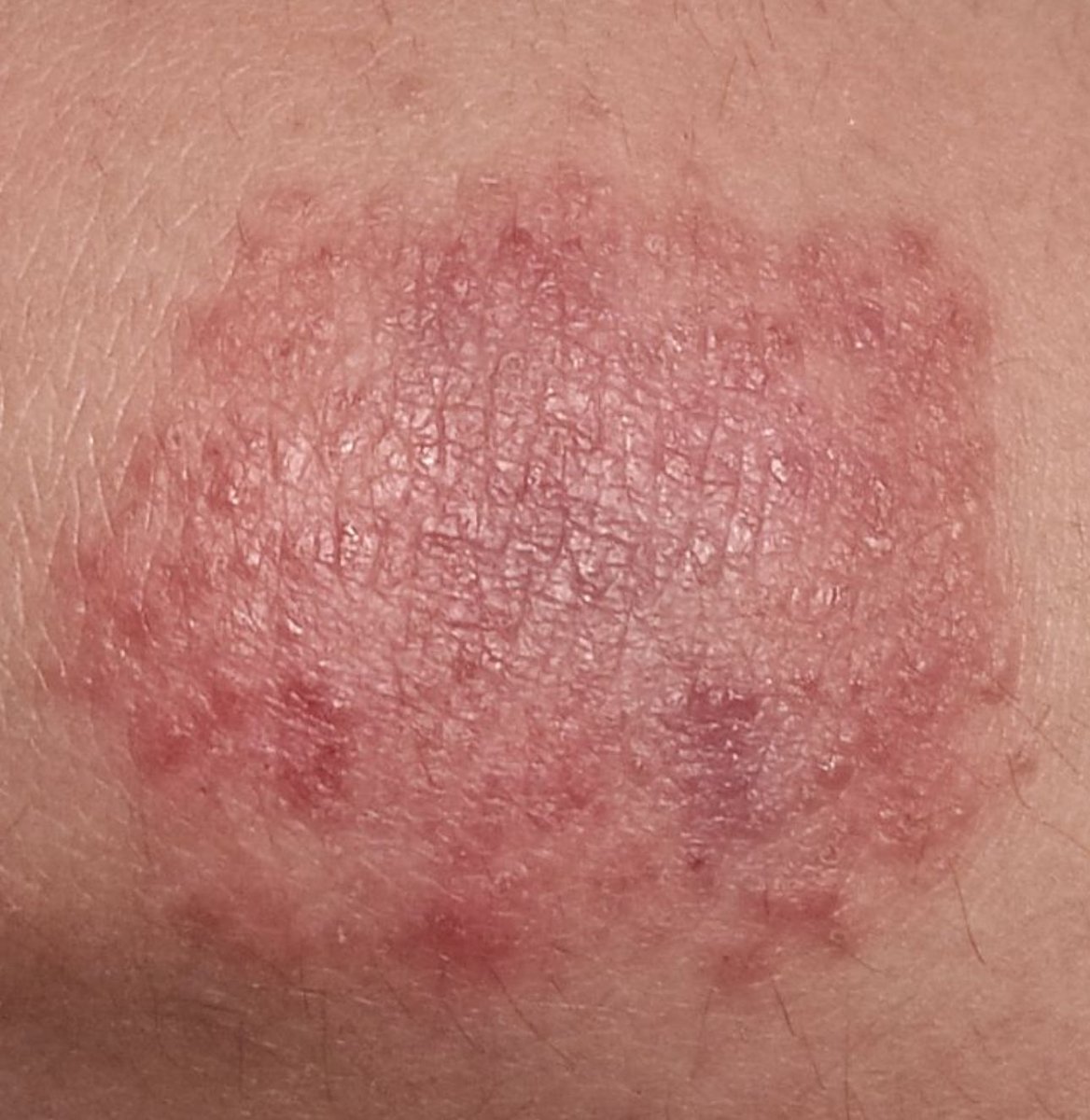 Medecin2famille's tweet image. #DocTocToc #Diagnostic #Traitement lésion érythémateuse un peu prurigineuse traitée sans succès par diprosone et apparemment amoxi (pourquoi?)  je pense à une dermatite herpétiforme.  Et vous ?