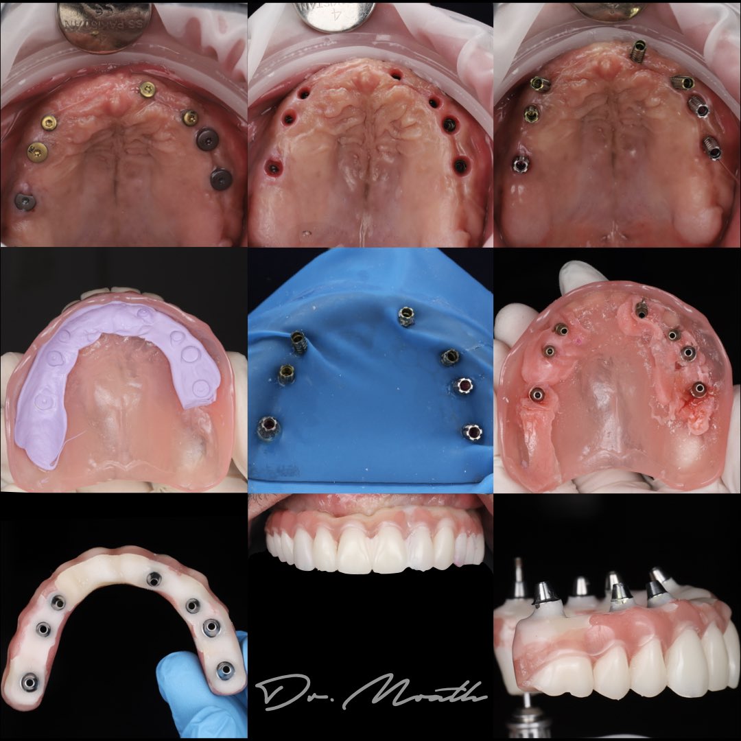 خطوات تغيير الطقم المتحرك الى طقم مؤقت ثابت على الزرعات (بعد الزراعه)

(Step-by-Step) protocol to converting denture to interim fixed prosthesis direct in the clinic