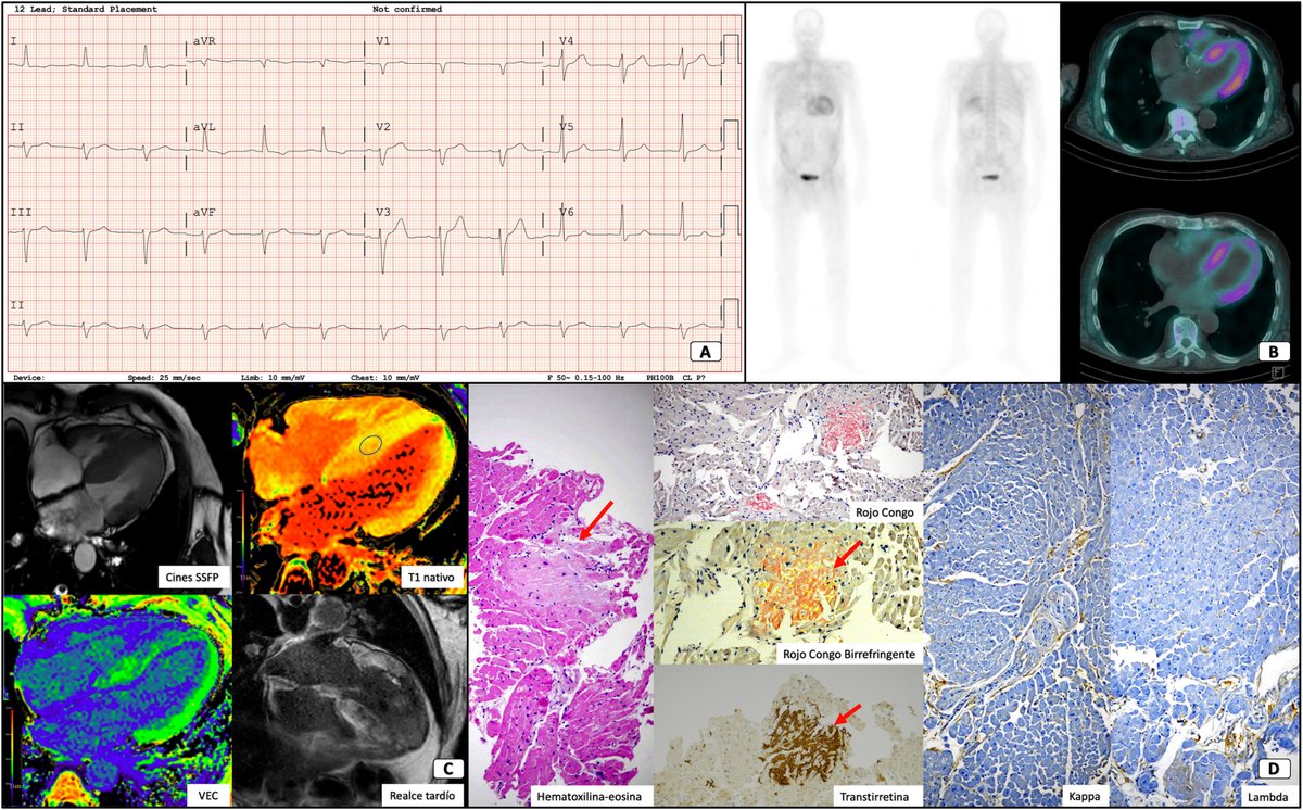 Insuficiencia cardiaca en paciente con mieloma múltiple #reccardioclinics @AngelHdez13 @reirosbachiller reccardioclinics.org//es-insuficien…