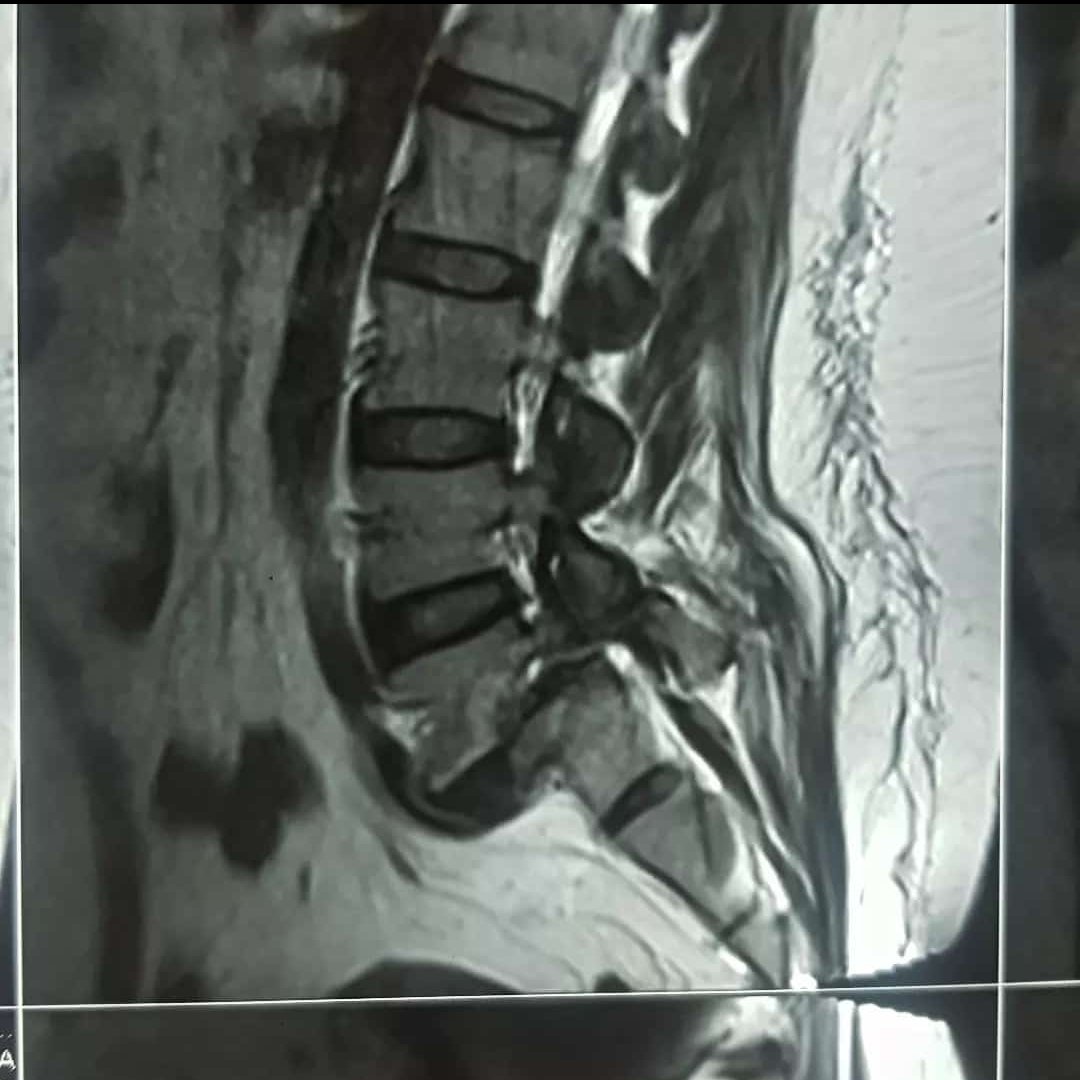 mo_ma1374's tweet photo. Hi, Today we had a 35 y/o lady, with Rt radicular leg pain and claudication. As you see she had a high grade spondylolisthesis L5/S1 and L5 foraminal narrowing. She underwent L4/L5/S1 fixation and TLIF(interbody cage)... https://t.co/EOAUCFSmUq