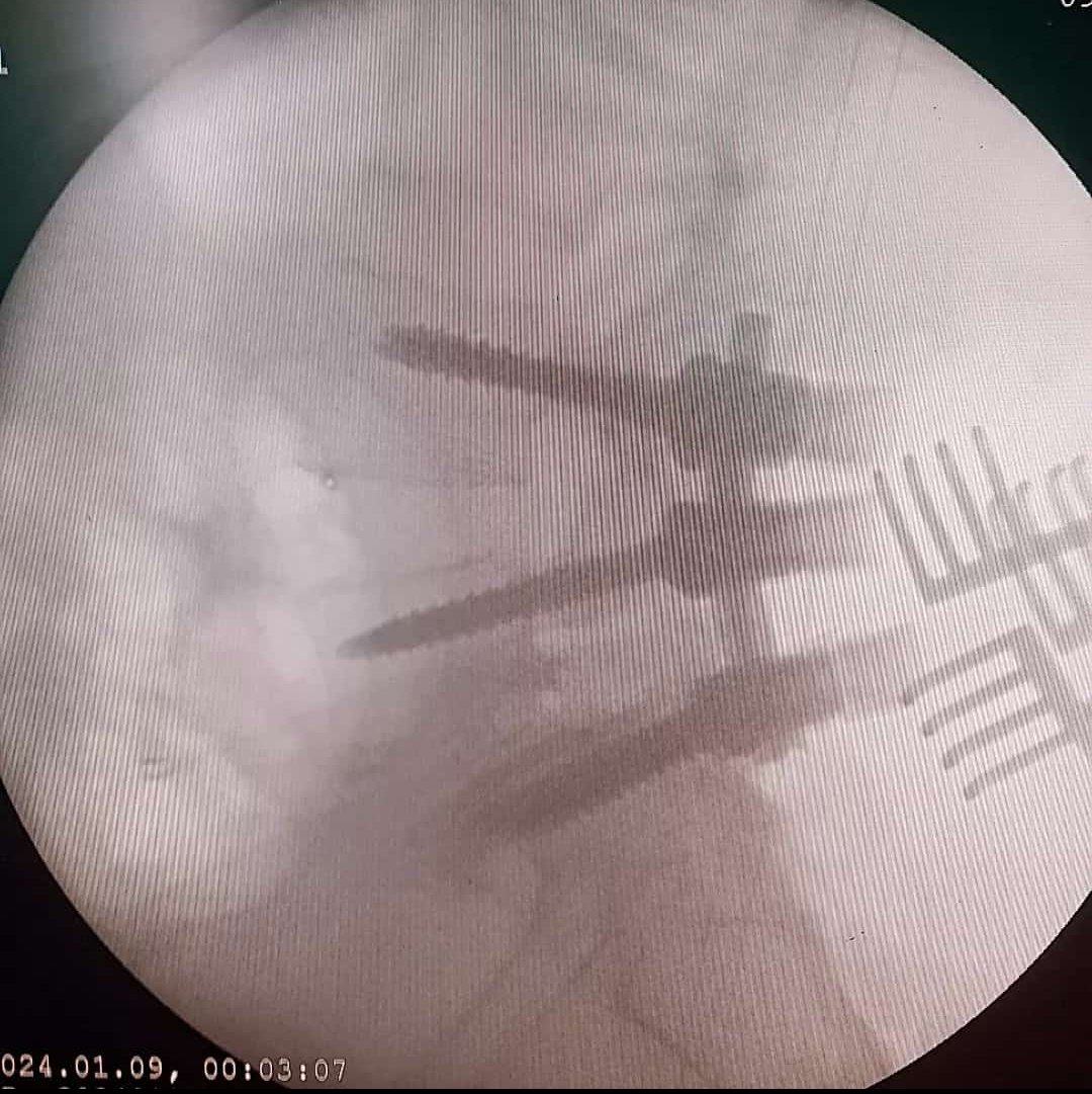 mo_ma1374's tweet photo. Hi, Today we had a 35 y/o lady, with Rt radicular leg pain and claudication. As you see she had a high grade spondylolisthesis L5/S1 and L5 foraminal narrowing. She underwent L4/L5/S1 fixation and TLIF(interbody cage)... https://t.co/EOAUCFSmUq