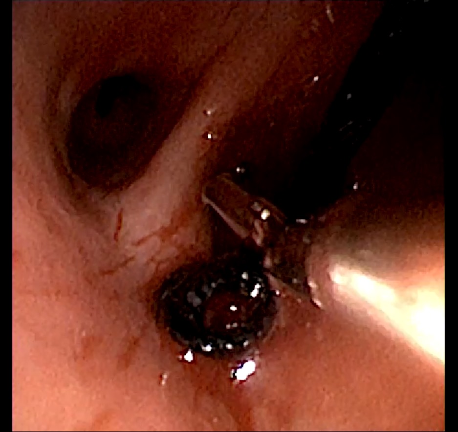 interneumo's tweet photo. Extracción de la madeja de hilo utilizando  diversas ténicas de intervencionismo: Broncoscopia Rígida/Flexible, pinza diente de ratón broncoscopica, coagulación con argón plasma para control de sangrado, crioterapia (3). https://t.co/7JpClx5OFS