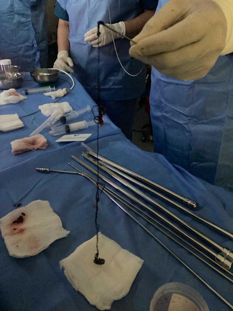 interneumo's tweet photo. Extracción de la madeja de hilo utilizando  diversas ténicas de intervencionismo: Broncoscopia Rígida/Flexible, pinza diente de ratón broncoscopica, coagulación con argón plasma para control de sangrado, crioterapia (3). https://t.co/7JpClx5OFS