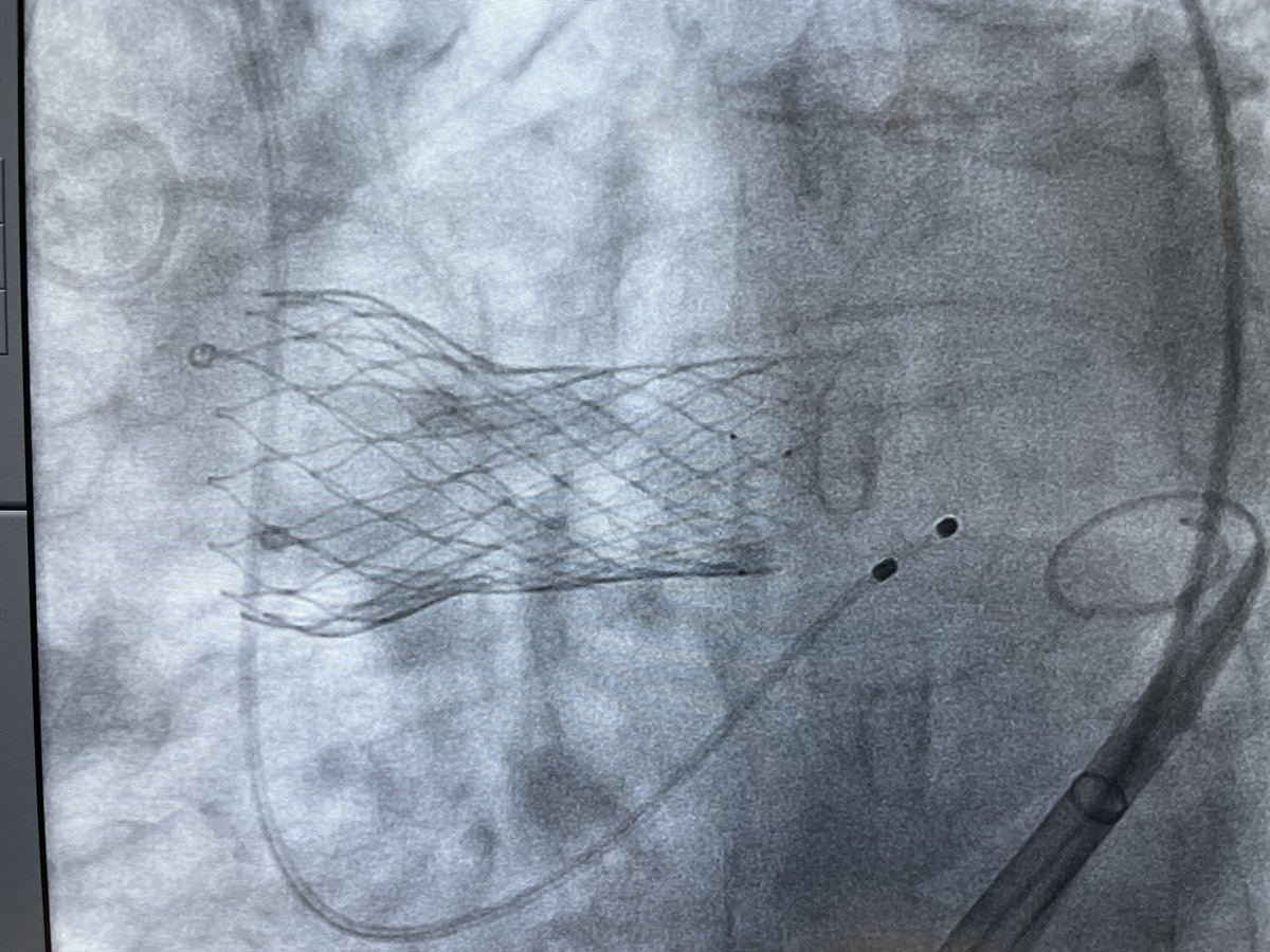 Gui Attizzani (@guiattizzanimd) on Twitter photo Horizontal aorta should not be a concern for #TAVR with #EvolutFX as it delivers smoothly and deploys very stable and coaxially. This bicuspid case we did today <a href="/UHhospitals/">University Hospitals</a> illustrates it well. Be careful pulling nosecone out. <a href="/MDT_StructHeart/">Medtronic Structural Heart</a> <a href="/SMPatelMD/">Sandeep M Patel, M.D.</a> @GabashaMD <a href="/vinesteves/">Vinicius Esteves,MD PhD FESC</a> Horizontal aorta should not be a concern for #TAVR with #EvolutFX as it delivers smoothly and deploys very stable and coaxially. This bicuspid case we did today <a href="/UHhospitals/">University Hospitals</a> illustrates it well. Be careful pulling nosecone out. <a href="/MDT_StructHeart/">Medtronic Structural Heart</a> <a href="/SMPatelMD/">Sandeep M Patel, M.D.</a> @GabashaMD <a href="/vinesteves/">Vinicius Esteves,MD PhD FESC</a>