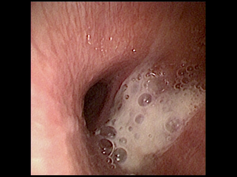 interneumo's tweet photo. INSOLITO!!! y misterio parcialmente resuelto: Hilo de sutura dentro del bronquio basal derecho comportándose como cuerpo extraño endobronquial obstruyendo el bronquio comun de los segmentos basales y produciendo infección crónica y colapso pulmonar segmentario basal (1). https://t.co/oGzCg3Z975