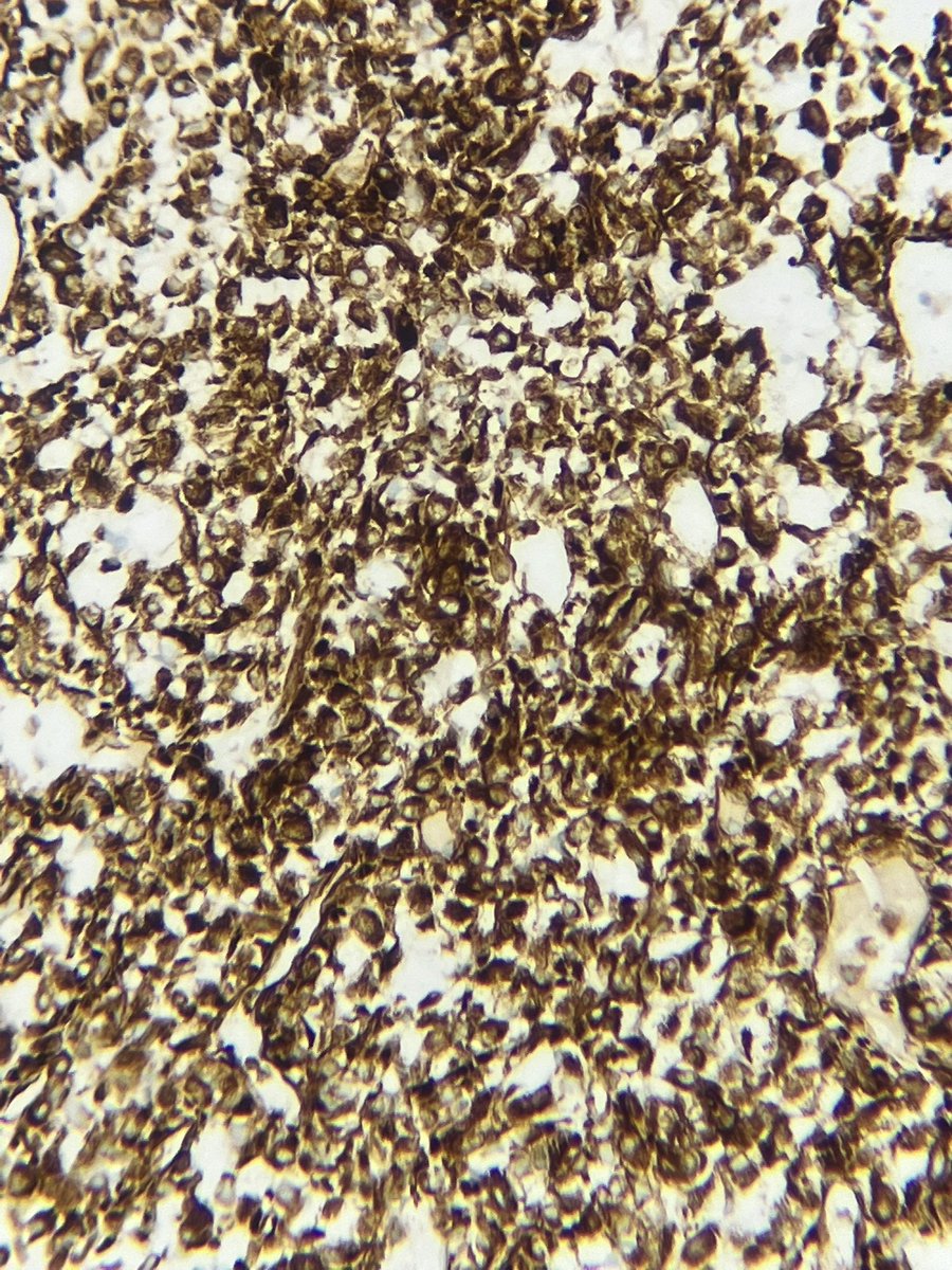 Immanuel_Paul30's tweet photo. The tumor cells showed diffuse cytoplasmic and membranous positivity for this immunomarker. What could this be ?
50s/F - Liver mass
#PathTwitter #impath https://t.co/sso4NSVefj