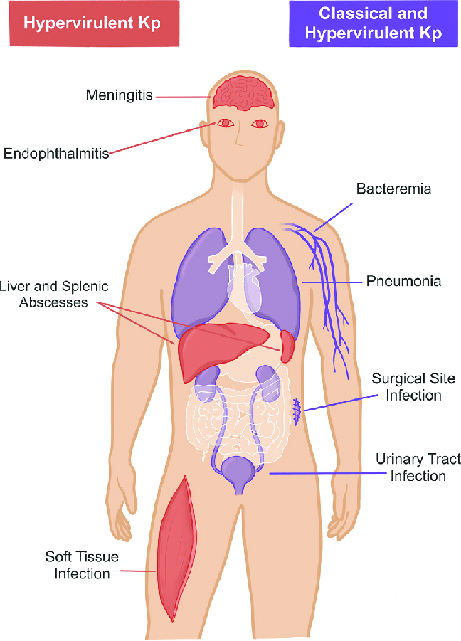 bioBlogia's tweet photo. ¿Por qué financiar ciencia importa?
Parto yo con mi Fondecyt. ¿Sabía Ud. que existen bacterias que no solo son super-resistentes a multiples antibióticos sino que también han desarrollado la capacidad de ser hipervirulentas, es decir, infectar otros tejidos y personas sanas? https://t.co/0KuyTynDaj