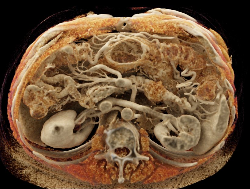 Carcinoma Tail of Pancreas