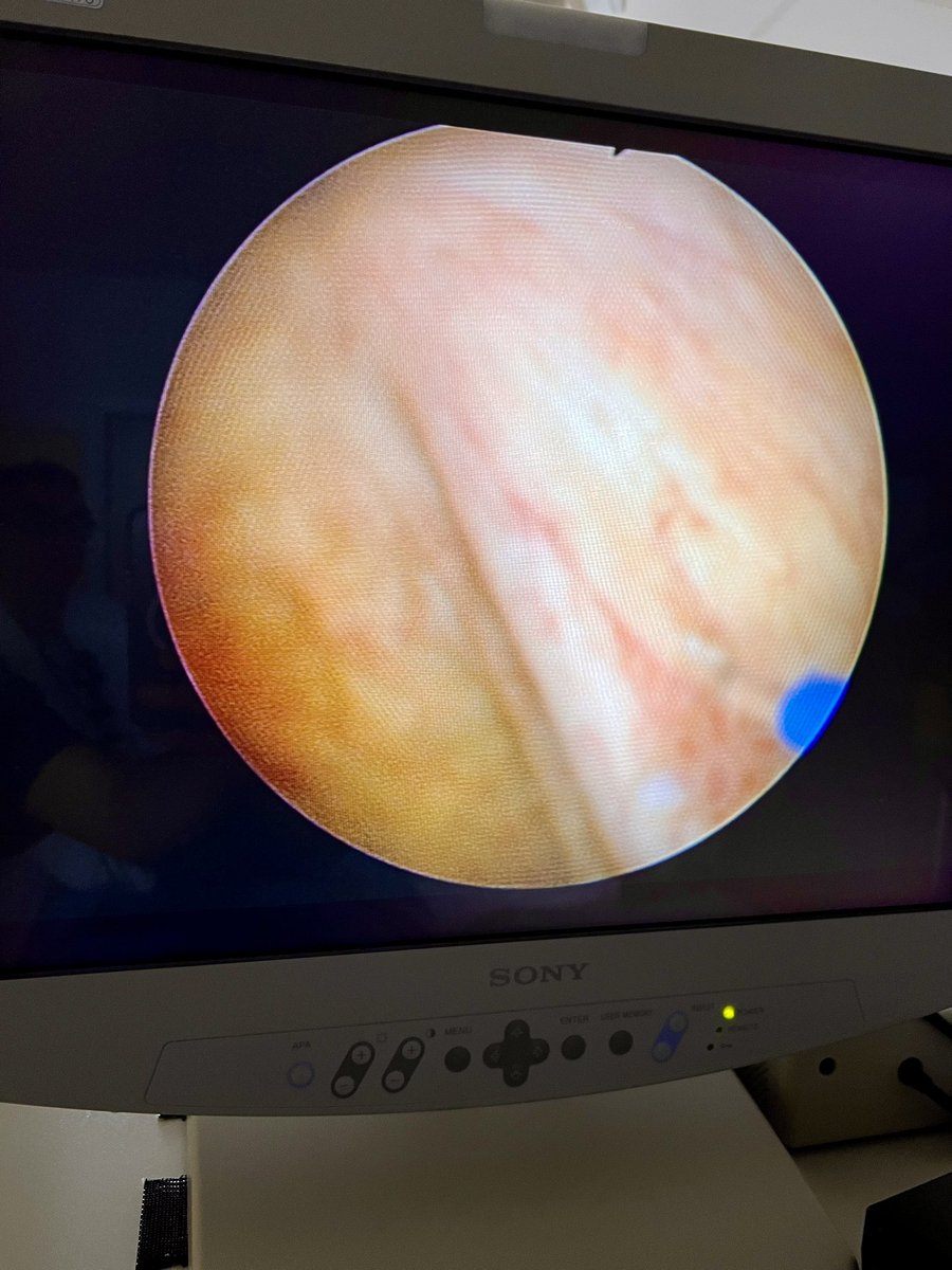 Luciano Ola (@luciano_ola_md) on Twitter photo Today we performed our first cases of office laser vaporisation with the brand new laser Leonardo of 2 small papillary recurrences in 2 patients with a history of small TaLGtumours. Great news for our patients suffering from #NMIBC
<a href="/biolitec/">Biolitec</a> <a href="/IvanoMorra/">Ivano Morra</a> <a href="/dalmetto/">Ettore Dalmasso</a> <a href="/OspedaleCuneo/">OSP. S. CROCE CUNEO</a> Today we performed our first cases of office laser vaporisation with the brand new laser Leonardo of 2 small papillary recurrences in 2 patients with a history of small TaLGtumours. Great news for our patients suffering from #NMIBC
<a href="/biolitec/">Biolitec</a> <a href="/IvanoMorra/">Ivano Morra</a> <a href="/dalmetto/">Ettore Dalmasso</a> <a href="/OspedaleCuneo/">OSP. S. CROCE CUNEO</a>