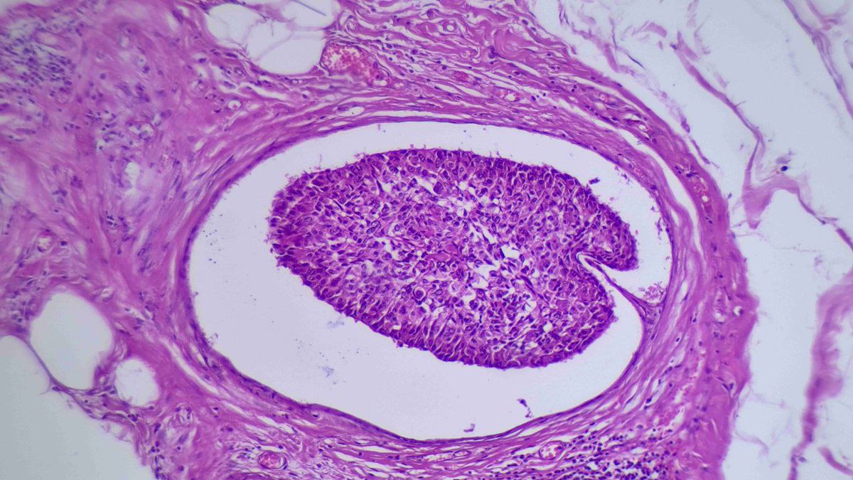 Drmerm's tweet photo. #BeautifulPath #pathtwitter #pathology #Xpath #breastcancer #breastpath https://t.co/t4Gxavrp4D