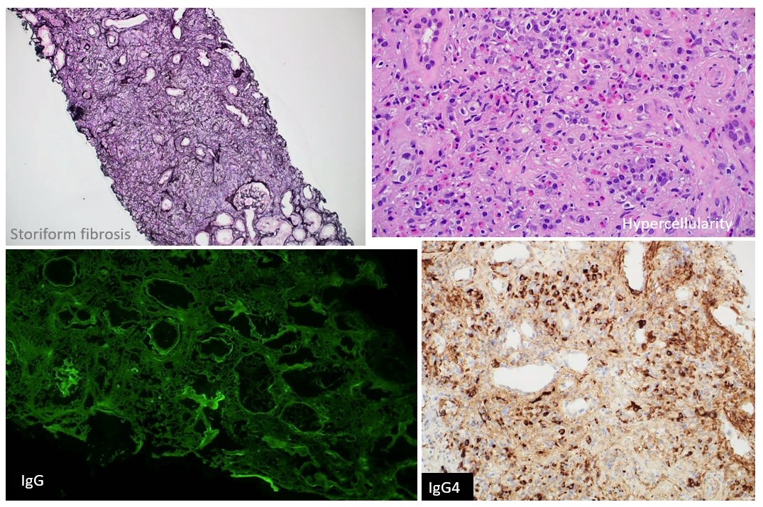 MCW_Nephrology's tweet image. Educational #Nephropath conference. 
@glom_busterMD discusses an interesting case of IgG4-related tubulointerstitial nephritis.
#MedEd #Nephrology