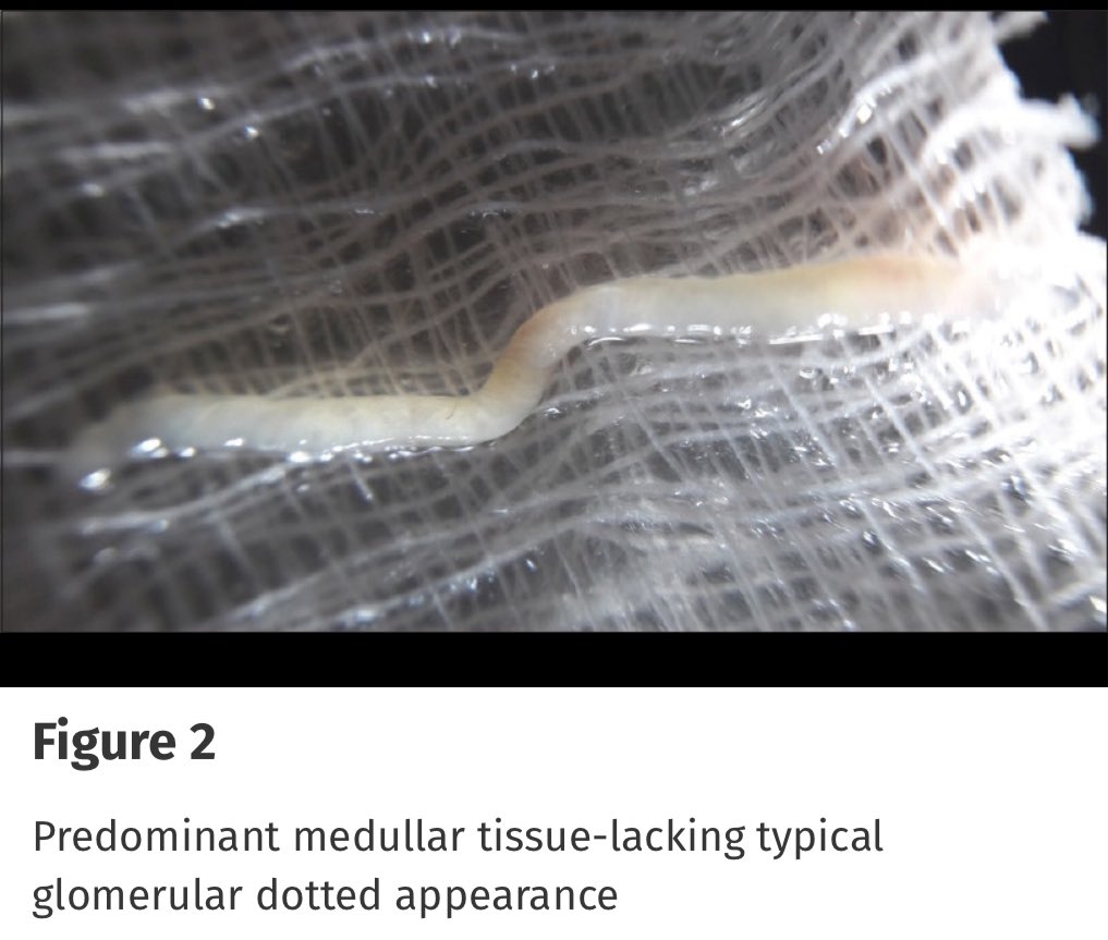 arvindcanchi's tweet photo. The seeds of this study I saw sown in a poster that I saw in #NephAvatar some years ago.
"Bedside Method to Check the Adequacy of Kidney Biopsy Sample with a Smartphone Camera and Macro Lenses: A Prospective Cohort Study" @SunyModi et al in the @indianjnephrol
https://t.co/qaO1JexAxV