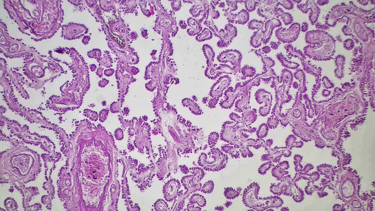 Drmerm's tweet photo. 😍😍😍
#BeautifulPath #pathtwitter #neuropath https://t.co/r6XUKEPPkJ