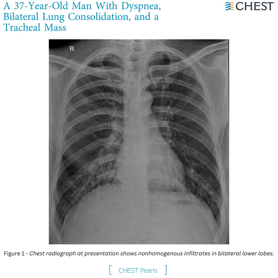 A 37-Year-Old Man With Dyspnea, Bilateral Lung Consolidation, and a Tracheal Mass What's the diagnosis? Read the #CHESTPearl in the January @journal_CHEST issue to find out: hubs.la/Q02fJkK70 #MedTwitter #MedEd