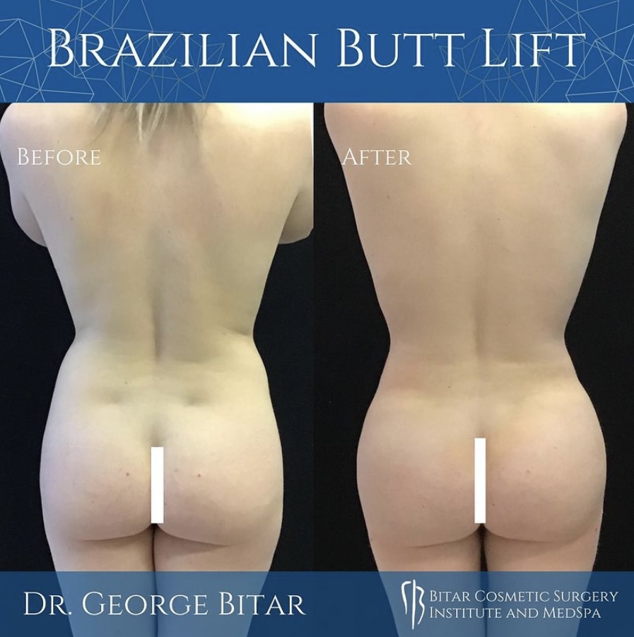 BitarInstitute's tweet photo. The recovery process after a Brazilian Butt Lift involves minimizing pressure on the buttocks to allow the transferred fat to settle! #BBLRecovery #PostOpCare https://t.co/VVZb60E197