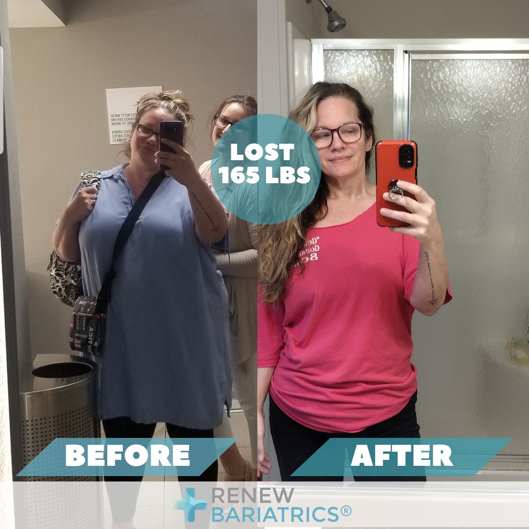 RenewBariatrics's tweet image. 🌟 A Life-Transforming Journey! 🌟

From 313lbs to 148lbs in under a year, size 22 to 7/8. 
&quot;After my surgery on May 31, 2022, I no longer need steroids for my autoimmune disease. At 45, chasing my 3-year-old is a breeze!&quot; 💖💪 #RenewYourLife #TransformationSuccess