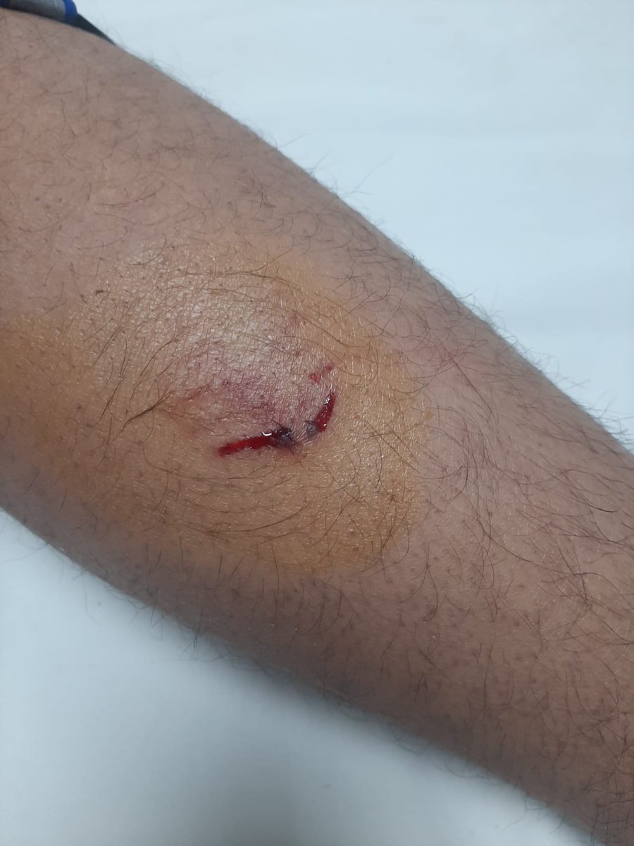 ravibhadoria's tweet photo. ग्रेटर नोएडा वेस्ट की हिमालय प्राइड सोसायटी में आवारा कुत्ते ने एक बच्चे को बुरी तरह काटा। निवासियों का कहना है कुत्ता प्रेमी गैंग के लोग सोसायटी में खाना खिलाने के बहाने आवारा कुत्तों को ले आये हैं।
बच्चे बूढ़े दहशत में हैं, नीचे पार्क में कुत्ते खेलते हैं। ग्रेटर नोएडा वेस्ट की लगभग हर सोसायटी में अब आवारा कुत्तों की भरमार होती जा रही है, एक दिन अवश्य क���त्ता प्रेमी गैंग और निवासी सड़कों पर भिड़ेंगे यदि इस समस्या और गैंग के आतंक का निराकरण नहीं हुआ तो। @OfficialGNIDA
