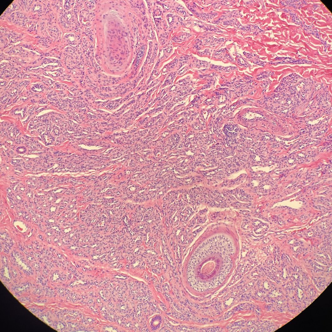 Patient complained that this neck mass kept bleeding on light touch - I can see why 😳 Kind of cool how the hemangioma grew around adnexal structures.

#BSTPath #PathTwitter #PathX