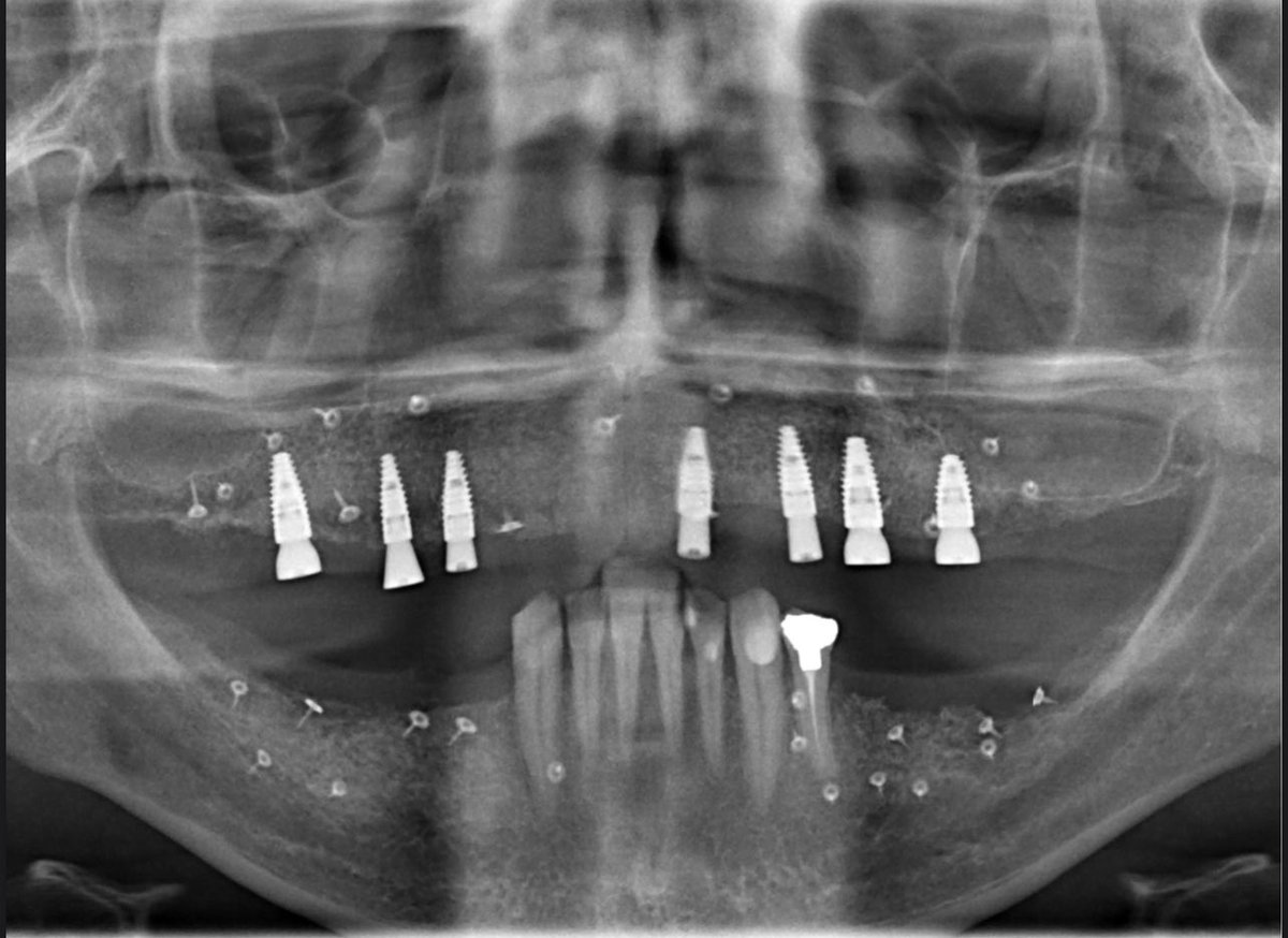 حاله كانت صعبه لكن بالتخطيط السليم والعلاج المتقن تم تغيير حياه المريض ..الحاله لمريض يشتكي من ذوبان شديد للعظم بعد اهمال وعلاجات خاطئة عملت زراعه عظم لكامل الفك العلوي والفك السفلي وبعد فتره التاءام العظم تم زراعه ٧ زرعات في الفك العلوي يلاحظ سماكه العظم واللثه حوالين الزرعات