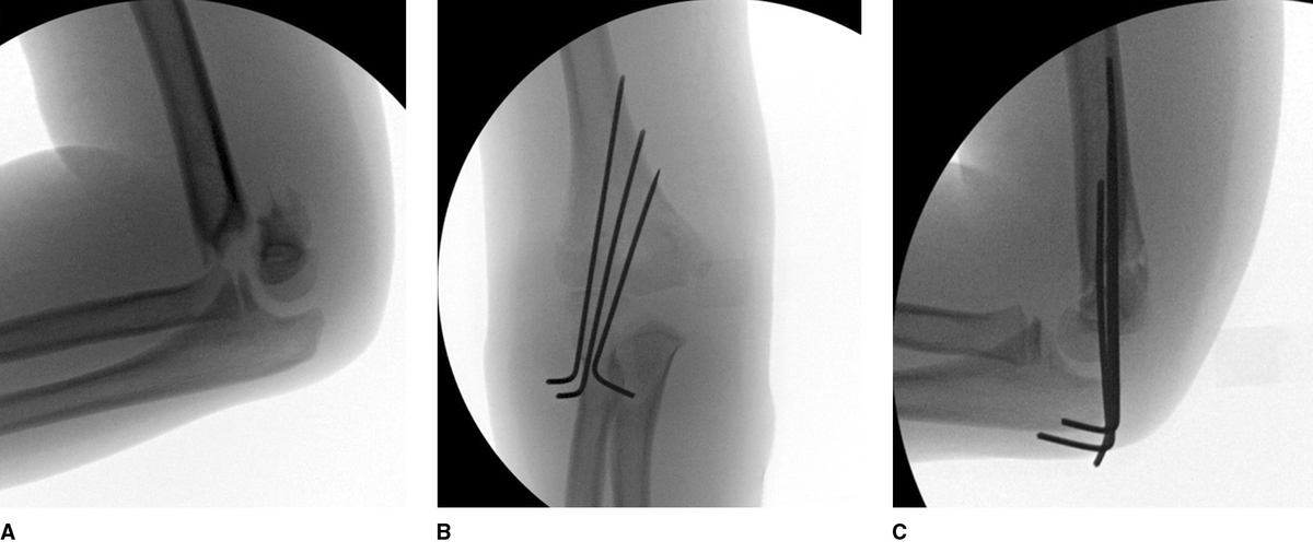 ortho_review's tweet photo. Q. What is the recommended pin placement in management of pediatric supracondylar fractures? #orthtwitter https://t.co/QWRZlGnQHb