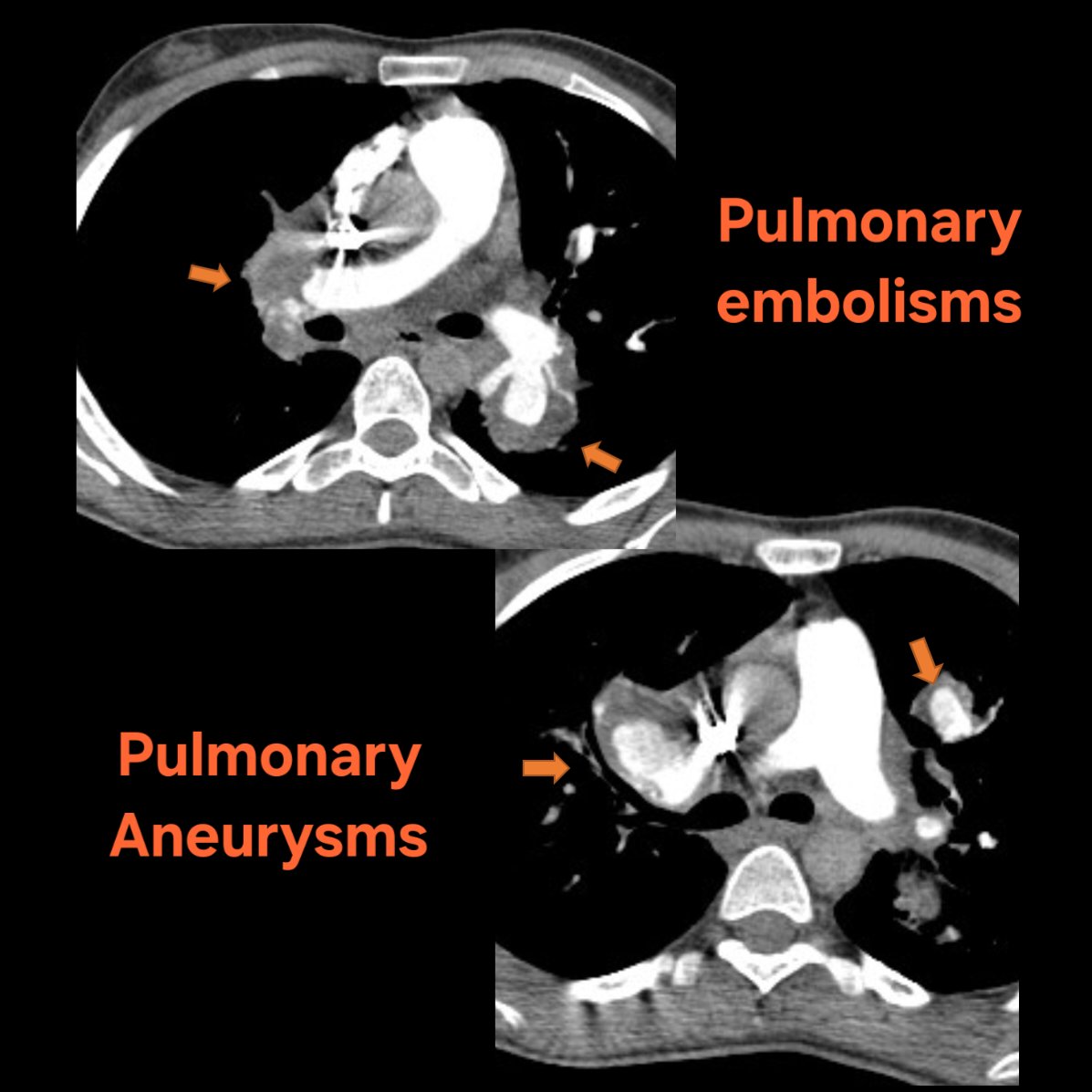 asunirad's tweet photo. CT Pulmonary Angio was ordered
#foamrad
#futureradres
#radiologyresidency https://t.co/gH70UkI5Vr