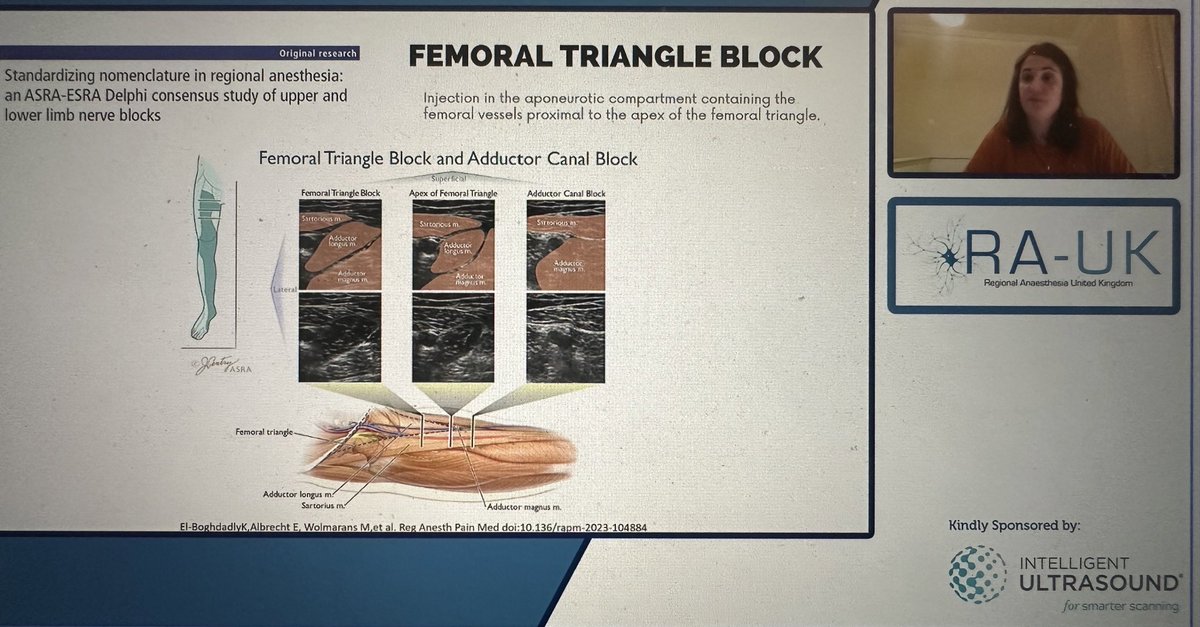 ajrmacfarlane's tweet photo. @mariapsebastian reminding us of adductor canal anatomy during @RegionalAnaesUK Plan A webinars

vs femoral triangle (look for pray 🙏🏼 sign)

Does it matter….?

➡️Less likely to block NVM if ACB - unless significant prox spread
➡️Little chance spread to popliteal plexus if FTB https://t.co/KZF4Ymkusu