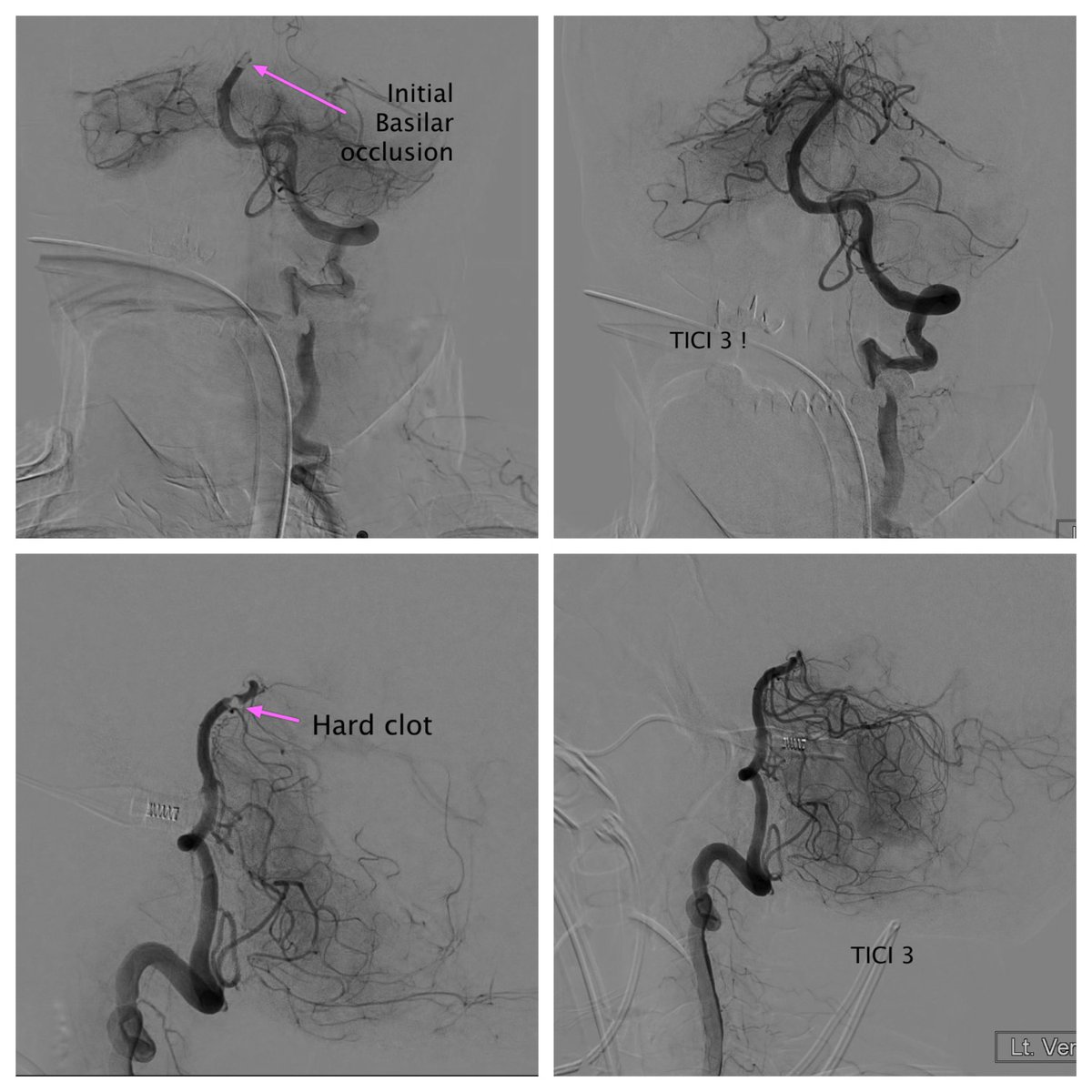 DavidAltschulMD's tweet image. #Hippo &amp;amp; #Cheetah @q_apel managing a really tortuous #posterior #circulation #basilar #stroke 2 clot parts, the soft red and the hard white! Getting the job done when stent retrievers and zoom couldn’t!!! #lovinit #iloveneurosurgery #neuroIR #cerebrovascular #neuroendovascular
