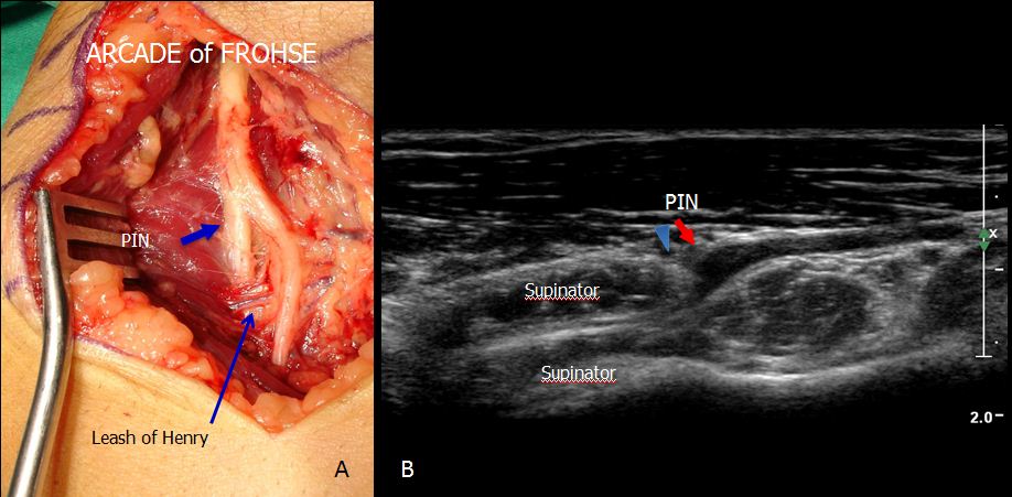 Ultrasound of the deep branch of the radial nerve around the distal edge of the supinator tunnel
epos.myesr.org/poster/esr/ecr…