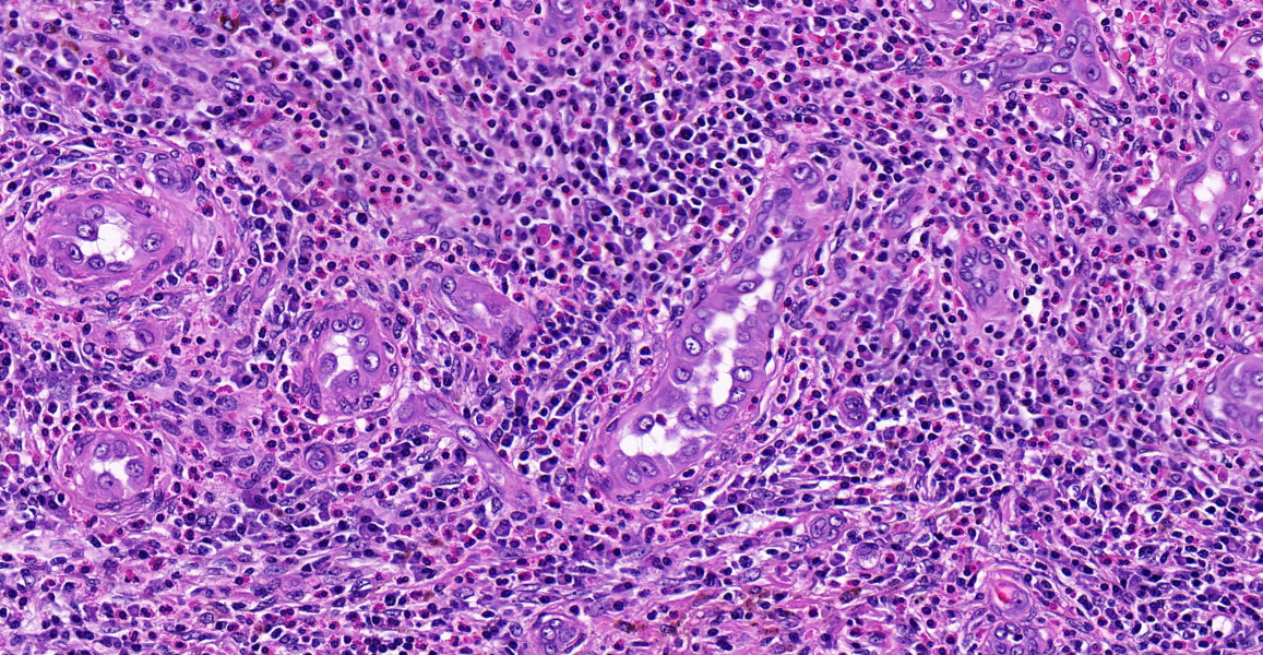 ⚕️Femur, adult male

#BSTpath #Endopath #GUpath #Pathtwitter #Pathresident

➡️Ill be posting less in the next few months for family reasons.