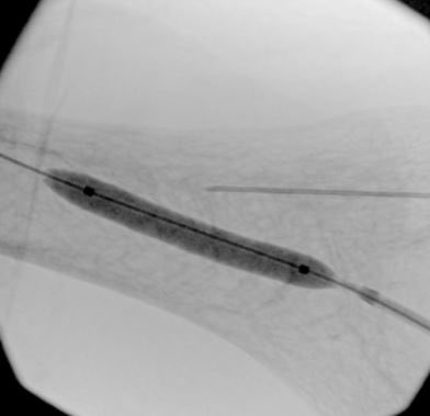Mamdouh Khayat (@mamdouhkhayatmd) on Twitter photo Unexpected problems present an opportunity for creativity. A patient with recent brachial-to-cephalic AV fistula creation. Unfortunate pseudoaneurysm from recent traumatic dialysis cannulation. Treated and salvaged with balloon-assisted thrombin injection. <a href="/ViveVascular/">Vive Vascular</a> Unexpected problems present an opportunity for creativity. A patient with recent brachial-to-cephalic AV fistula creation. Unfortunate pseudoaneurysm from recent traumatic dialysis cannulation. Treated and salvaged with balloon-assisted thrombin injection. <a href="/ViveVascular/">Vive Vascular</a>