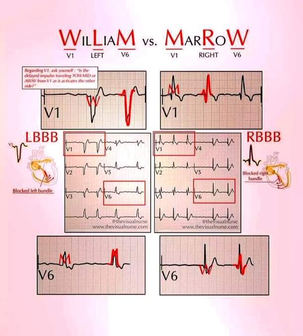walinjom's tweet photo. The difference between right &amp; left 
BUNDLE BRANCH BLOCK. https://t.co/GAAmGVJ0k7