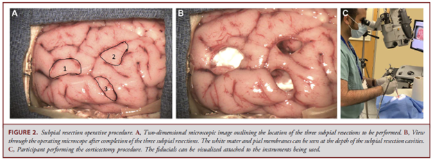 Neurosurgical Simulation and AI Learning Centre (@ai_simcentre) on Twitter photo <a href="/AI_SimCentre/">Neurosurgical Simulation and AI Learning Centre</a> congradulates Abdulrahman, Nour + co-authors for article entitled: Continuous Instrument Tracking in a Cerebral Corticectomy Ex Vivo
Calf Brain Simulation Model: Face and Content Validation: published in Oper Neurosurg
Ultimate goal the "Intelligent Operating Room" <a href="/AI_SimCentre/">Neurosurgical Simulation and AI Learning Centre</a> congradulates Abdulrahman, Nour + co-authors for article entitled: Continuous Instrument Tracking in a Cerebral Corticectomy Ex Vivo
Calf Brain Simulation Model: Face and Content Validation: published in Oper Neurosurg
Ultimate goal the "Intelligent Operating Room"