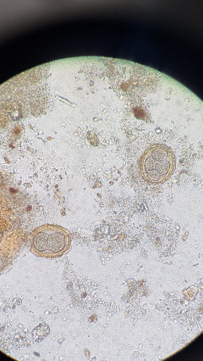 This is amazing and cool to see. Admittedly, I have not seen this often at all. Continued development of embryos in Ascaris eggs...in fixative! Talk about resilient 🪱!
#parasitology 
<a href="/ParasiteGal/">Bobbi Pritt, MD</a> <a href="/ARUPLabs/">ARUP Laboratories</a>