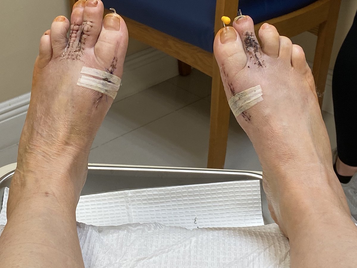 Got the staples and the staples out today but 2 weeks more off my feet and in the boots….