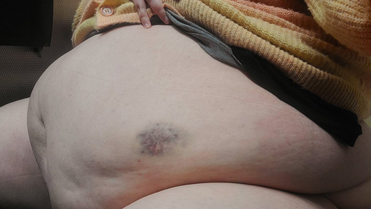 doughydarling's tweet photo. It's supposed to get frigidly cold soon 🥶 who wants to send this blubbery babe some cash to fatten up in preparation? I have content for sale! 

also check out the bruise @thriftyfeedee gave me from groping this soft tum 💕 https://t.co/4qMlkSHzK7
