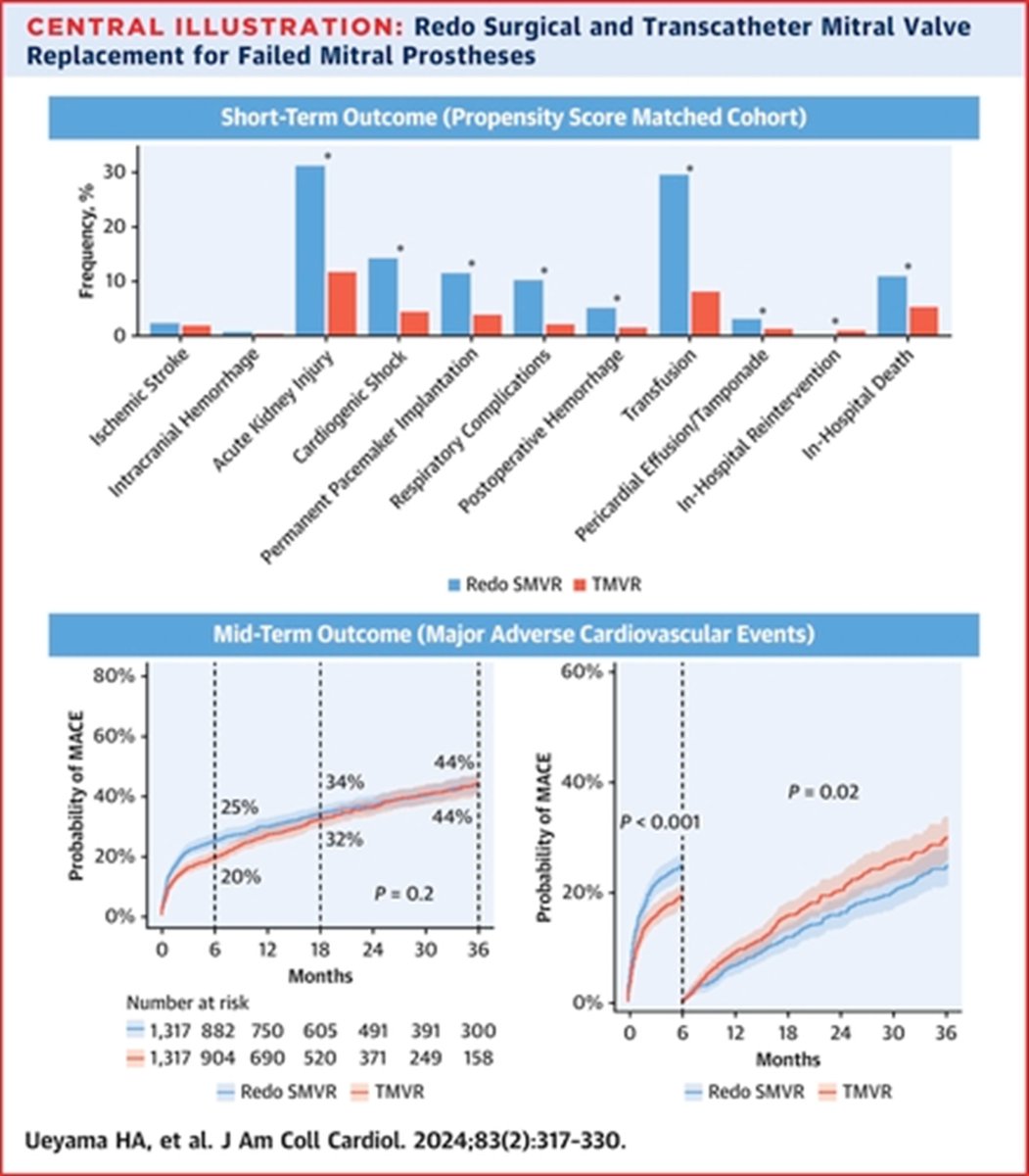 In #JACC, @mw_sherwood @anvoramd provide perspective & context for results of analysis by Ueyama et al of data on reoperation vs TMVR in patients with failed mitral prostheses jacc.org/doi/10.1016/j.… jacc.org/doi/10.1016/j.…