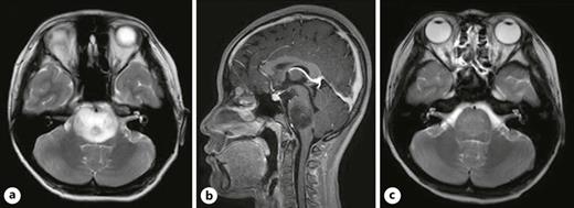 OphthaKarger's tweet photo. Two Pediatric Patients with Acute Acquired Comitant Esotropia as the First Symptom of Brainstem Tumor: A Case Report
โก๏ธ https://t.co/9JxgJSrYsK
โ๏ธ Yagasaki A. et al.
๐ #CaseRepOphthalmol
#OpenAccess https://t.co/wLqxDKEJsa