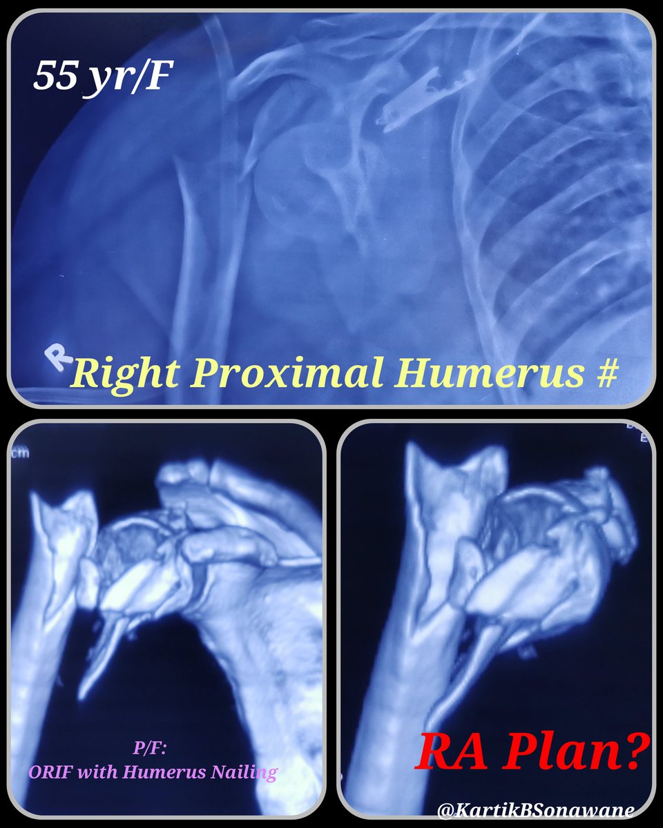 KartikBSonawane's tweet photo. What's ur RA Recipes for Such Patient?

#ProximalHumerusFractures
#RAinProximalHumerusSx
#PainManagementinHumerusSx

Patient: 55yr/F 

Diagnosis: 
Rt Proximal Humerus #

Plan:
P/F ORIF with Humerus Nailing https://t.co/zPCC4eMxMA