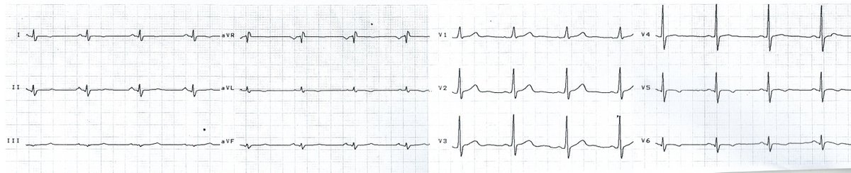 Мкс Рмах (@maxromanchenko) on Twitter photo Chest pain, "subtle" ECG changes.
Second ECG - 14 days after PCI.
Some more info on this case:
therapy.odmu.edu.ua/clinical-cases…
<a href="/RobertHermanMD/">Robert Herman, MD, PhD</a> <a href="/smithECGBlog/">Stephen W. Smith</a> Chest pain, "subtle" ECG changes.
Second ECG - 14 days after PCI.
Some more info on this case:
therapy.odmu.edu.ua/clinical-cases…
<a href="/RobertHermanMD/">Robert Herman, MD, PhD</a> <a href="/smithECGBlog/">Stephen W. Smith</a>