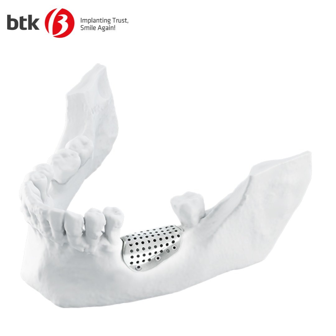 KwNoms's tweet image. GBR MESHES 3D MESH
THE IDEAL, CUSTOMISED SOLUTION FOR GUIDED BONE REGENERATION
It allows the biomaterial to adapt perfectly to the patient’s bone anatomy and reduces the duration of surgery, thereby enhancing the success of bone regeneration.

#NOMS #Subperiosteal #Implantsystem