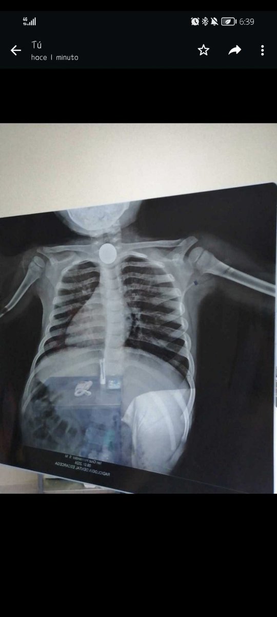 DSPedia21's tweet photo. Ingesta de cuerpo extraño. https://t.co/V05Lz2WEbY