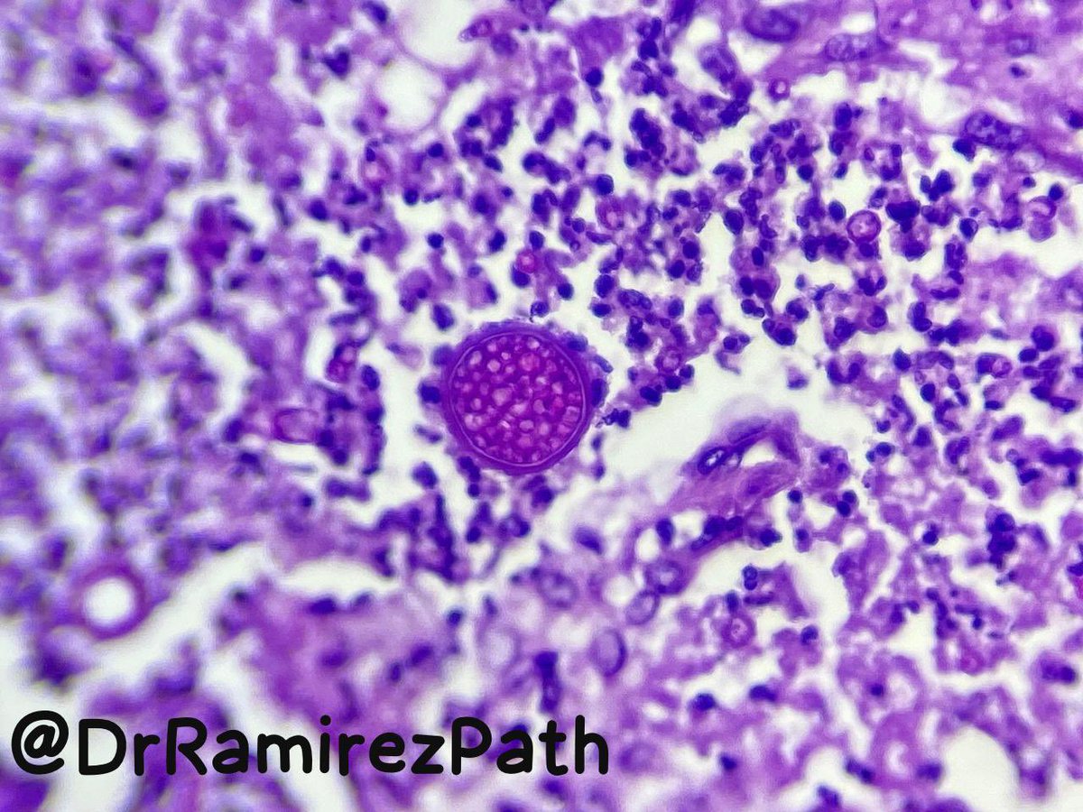 DrRamirezPath's tweet photo. 34-year-old woman with productive cough and fever. Lung Tissue (Autopsy)

Dx. Coccidioidomycosis (Spherules)

#pathology #microbiology 🔬 https://t.co/lV3y02Ek6g