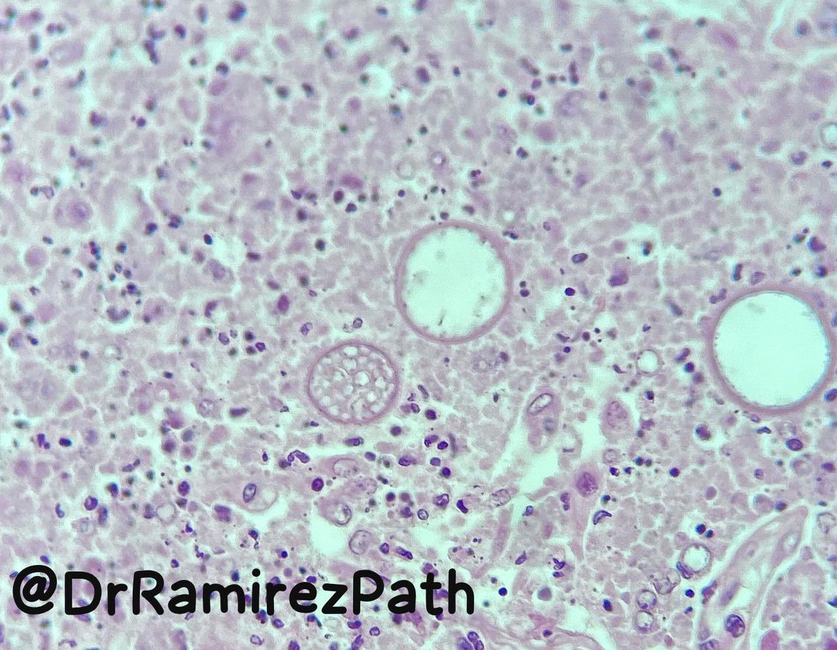 DrRamirezPath's tweet photo. 34-year-old woman with productive cough and fever. Lung Tissue (Autopsy)

Dx. Coccidioidomycosis (Spherules)

#pathology #microbiology 🔬 https://t.co/lV3y02Ek6g