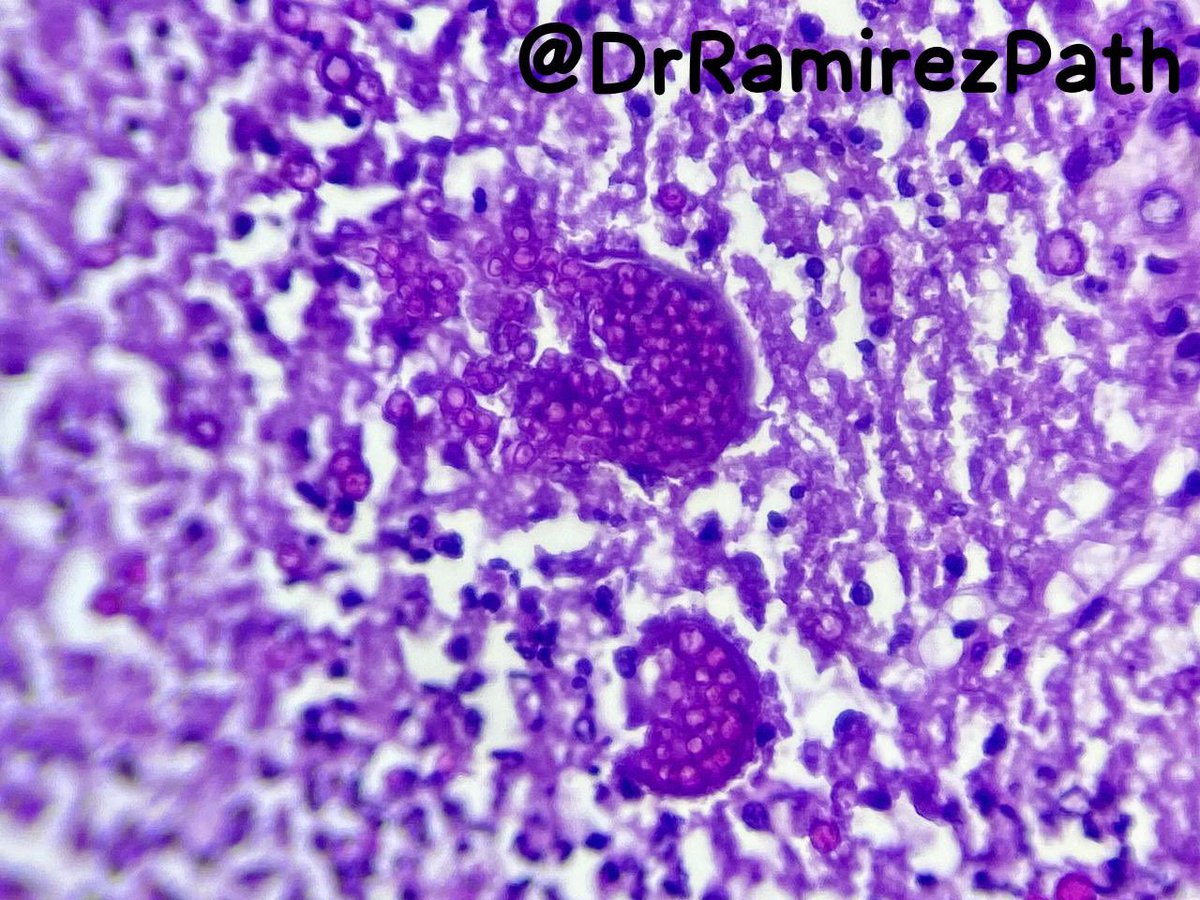 DrRamirezPath's tweet photo. 34-year-old woman with productive cough and fever. Lung Tissue (Autopsy)

Dx. Coccidioidomycosis (Spherules)

#pathology #microbiology 🔬 https://t.co/lV3y02Ek6g