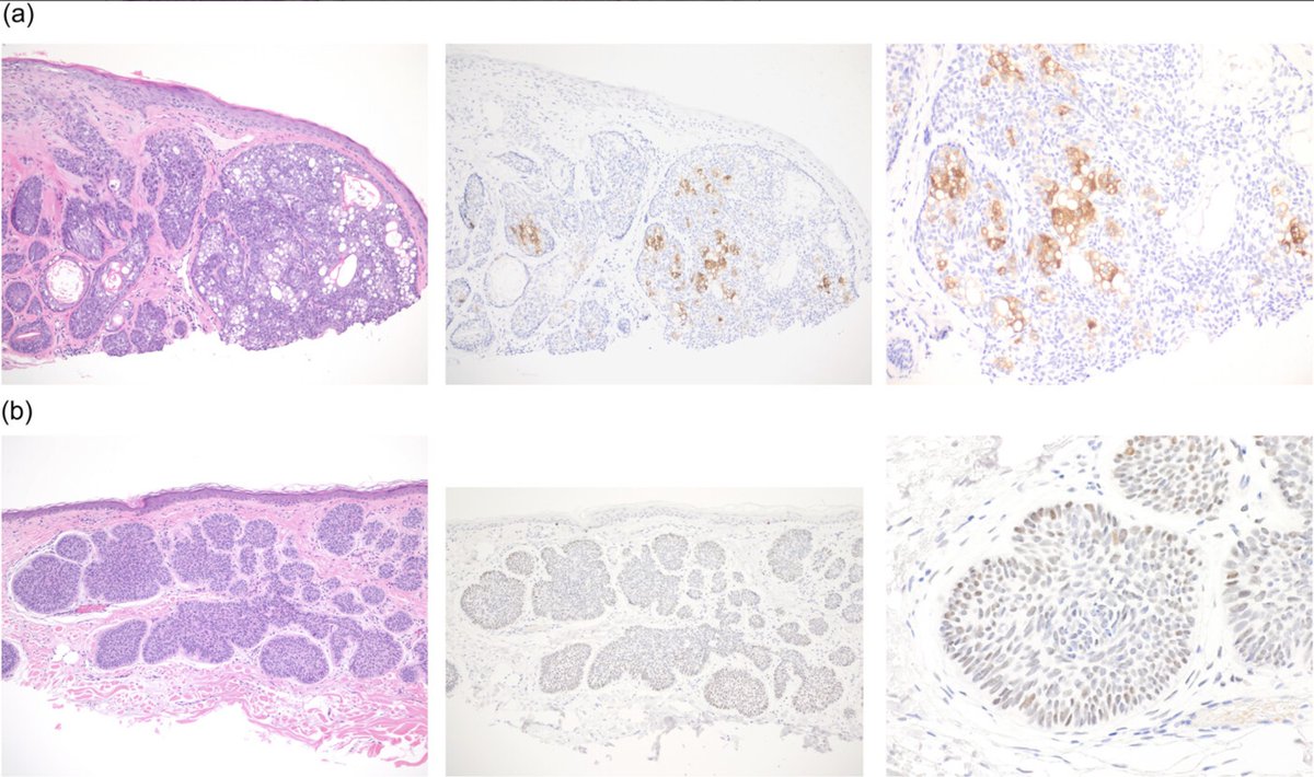 MSDoost's tweet photo. We found that PRAME expression was strong, patchy and cytoplasmic in #sebaceous carcinomas (a) vs weak, diffuse and nuclear in #BCC (b) https://t.co/5qIJiY3dm6