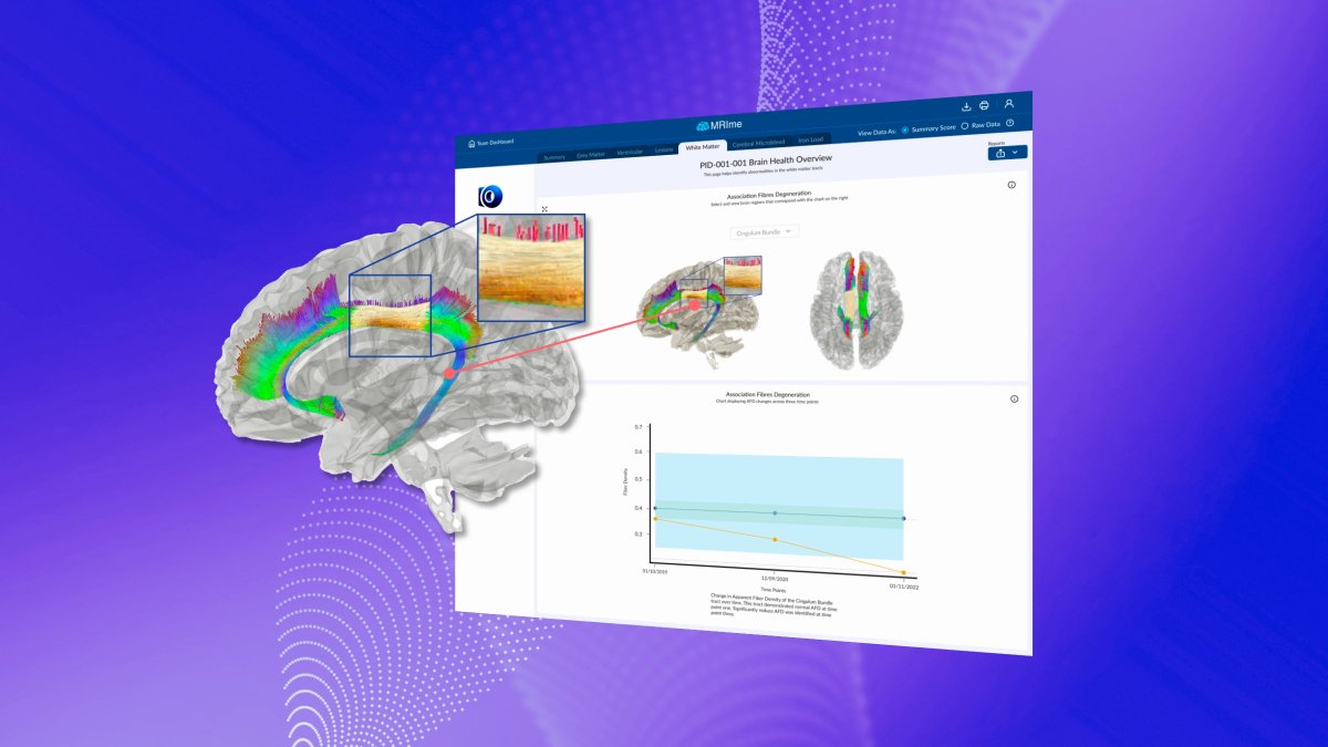 braincastai's tweet photo. 🔬 Tackling TBI Heterogeneity 🧠 Tracking white matter integrity through diffusion MRI unveils nuances in Mild TBI Recovery dynamics. Our software system enhances this, offering insights alongside cognitive and functional assessments. #Neuroscience #TBI #BrainCast https://t.co/QXQOLj8X3V