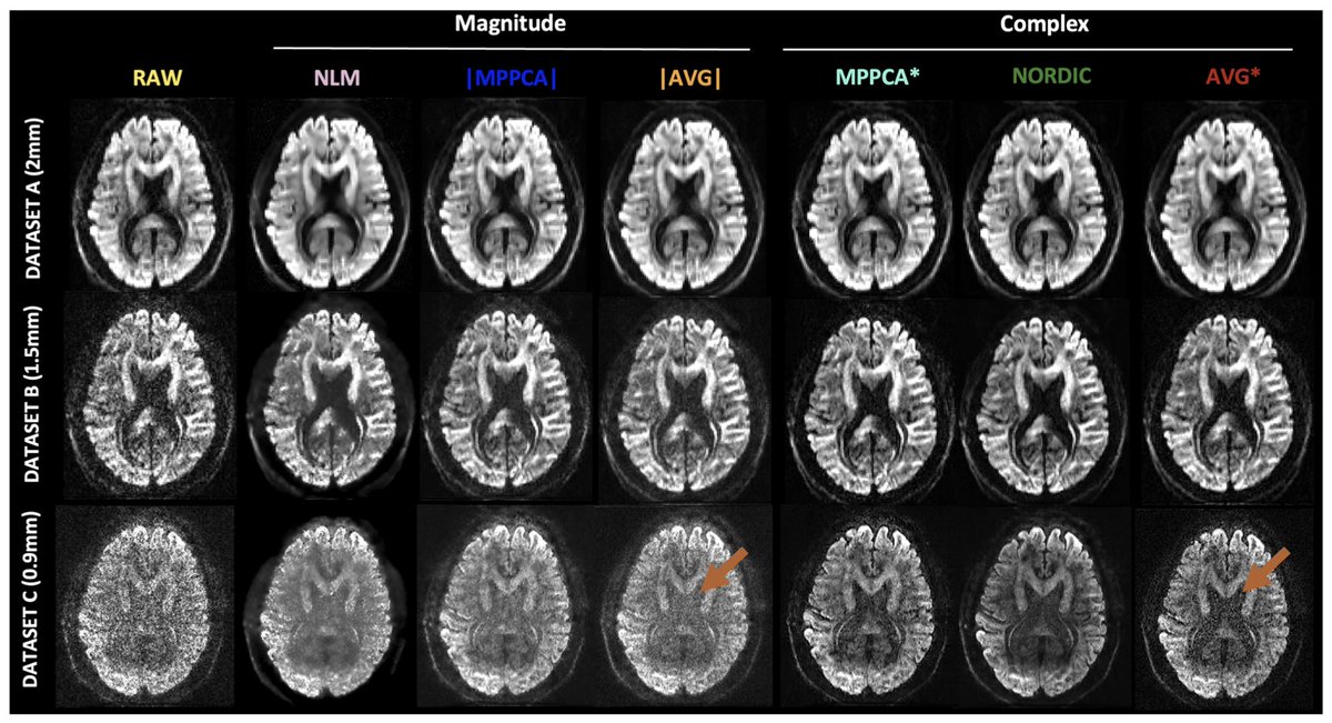 New paper in Imaging Neuroscience @mitpress by Jose Pedro Manzano Patron, Stamatios N. Sotiropoulos, et al: Denoising diffusion MRI: Considerations and implications for analysis doi.org/10.1162/imag_a…